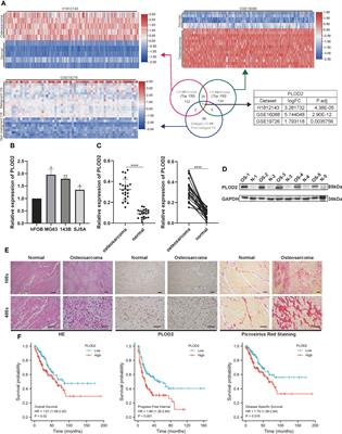 PLOD2 high expression associates with immune infiltration and facilitates cancer progression in osteosarcoma